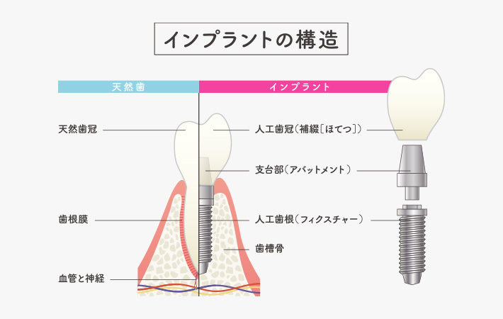 インプラントとは