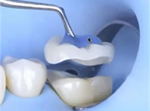 オクルーザルベニア