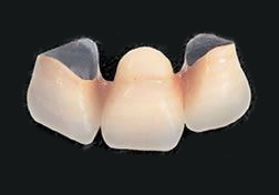 硬質レジン前装