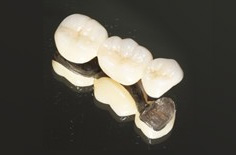 セラミックブリッジ