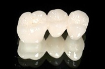 オールセラミック(e-max)ブリッジ